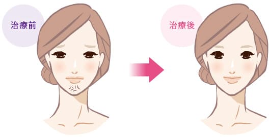 あごの表情シワの治療前と治療後のイラスト